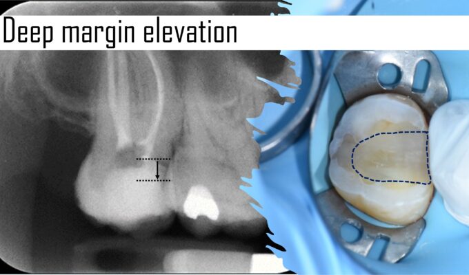 2024 Student Program: Deep Margin Elevation in the indirect workflow in restorative dentistry