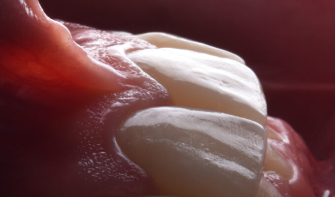 2027 Advanced Anterior Composite Restorations: Guidelines to High-End Esthetics