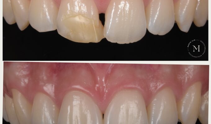 Anterior Layering